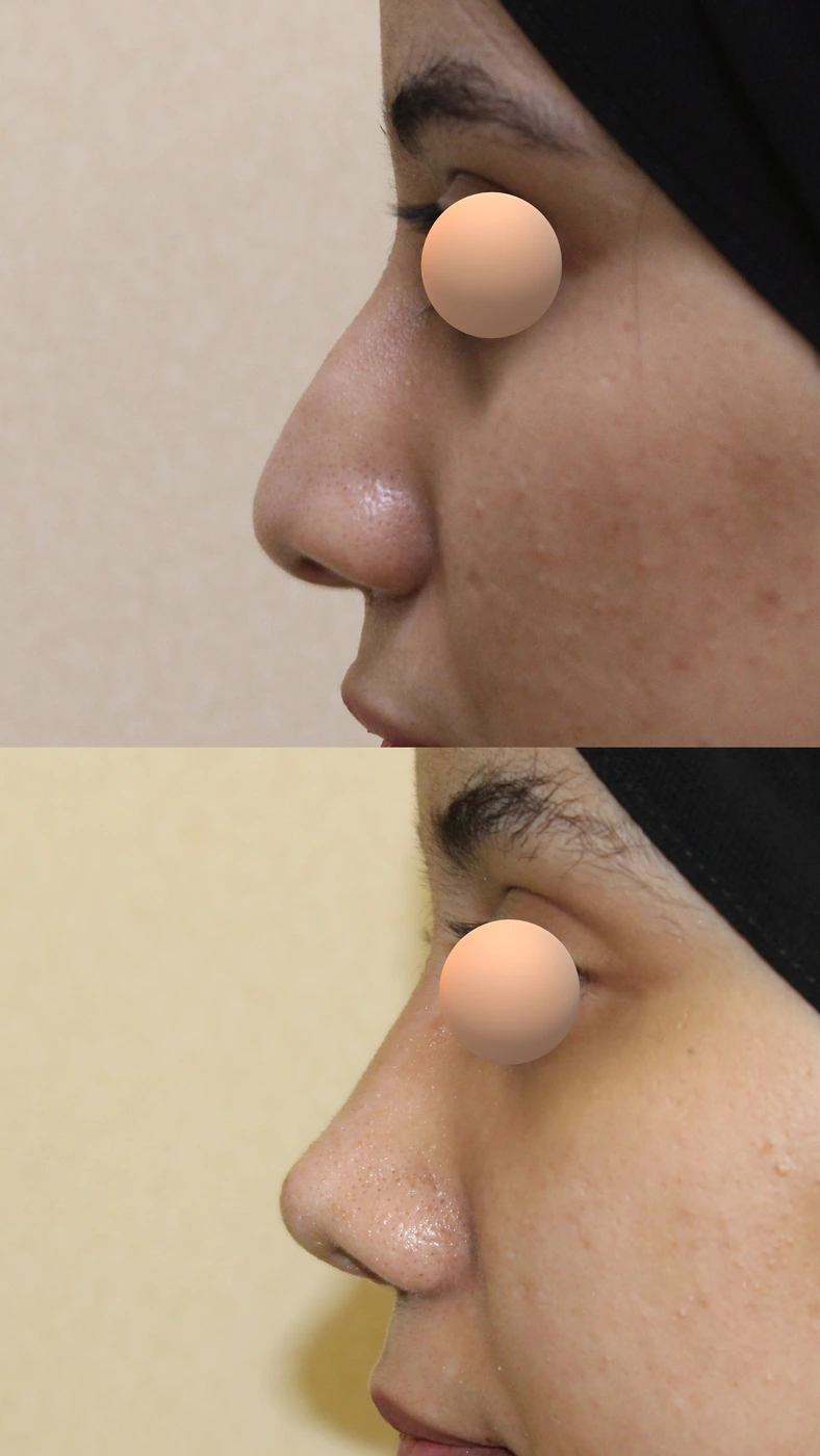 تجميل الأنف المنحرف — الجانب الأيسر