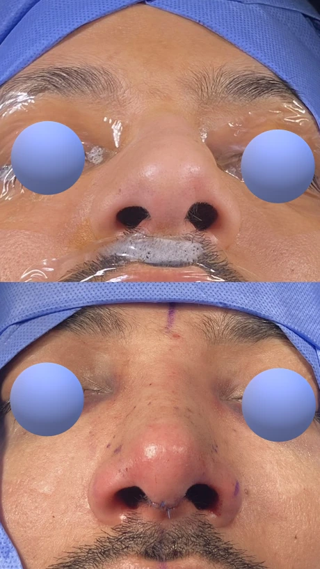 تجميل الأنف للرجال — من الأسفل