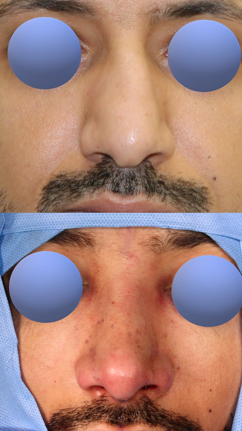 تجميل الأنف للرجال — من الأمام
