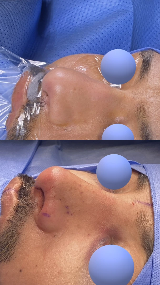 تجميل الأنف للرجال — زاوية مائلة يسارًا
