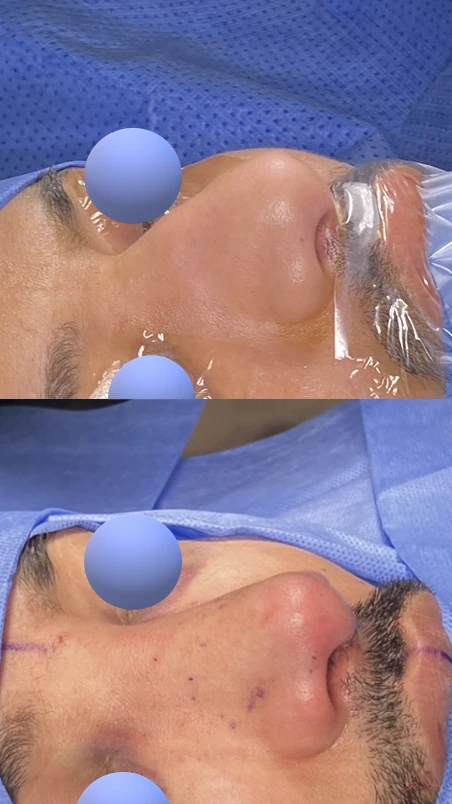 تجميل الأنف للرجال — زاوية مائلة يمينًا