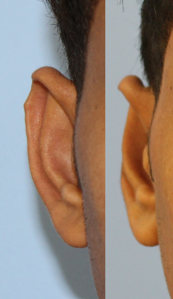 تجميل الأذن — الأذن اليمنى