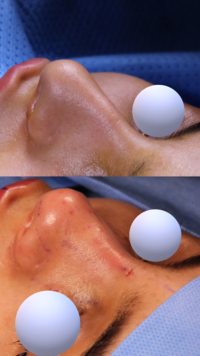 تجميل الأنف بالطريقة المغلقة والمحافظة — زاوية علوية يسارًا