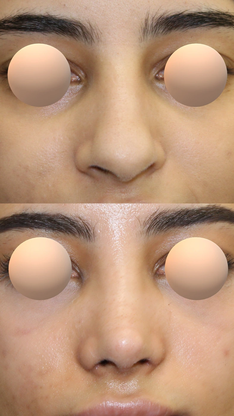 تجميل الأنف · الحالة الثالثة — من الأمام