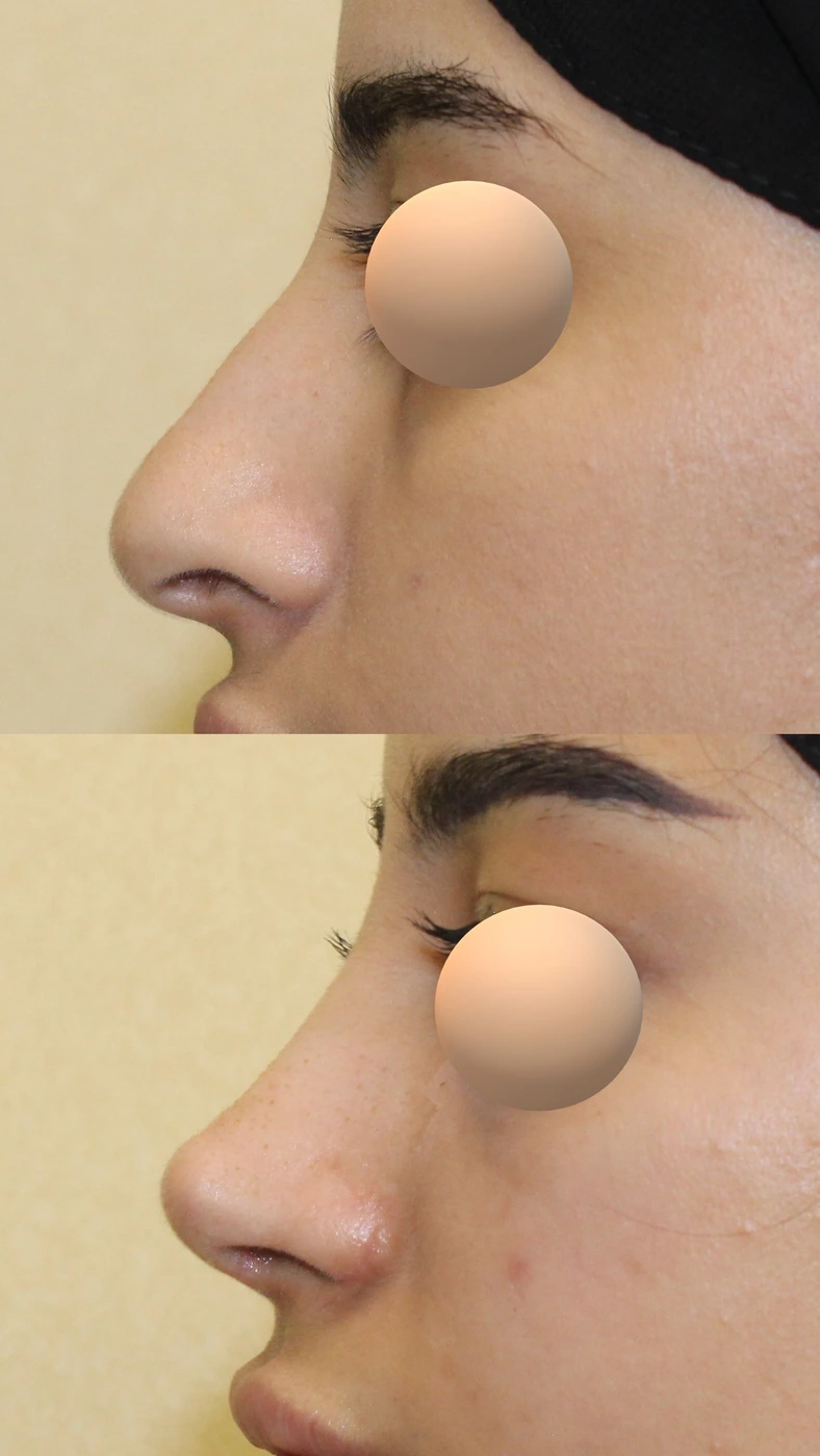 تجميل الأنف · الحالة الثالثة — الجانب الأيسر
