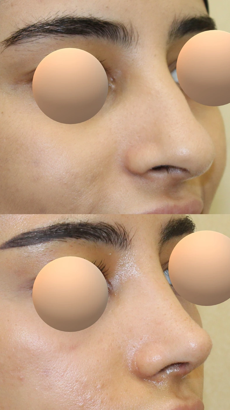 تجميل الأنف · الحالة الثالثة — زاوية مائلة يمينًا