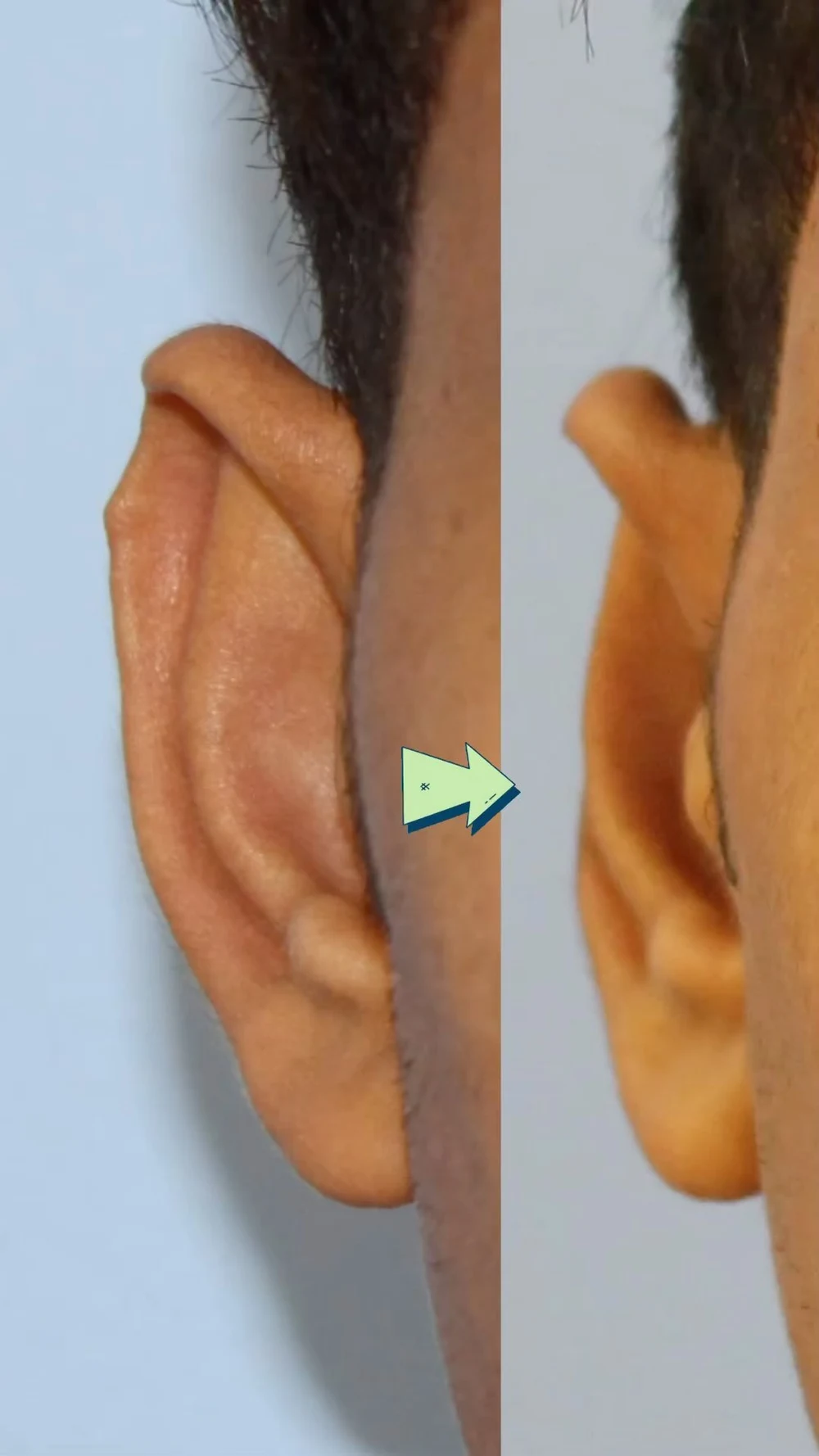 مقارنة لحالة تجميل الأذن البارزة