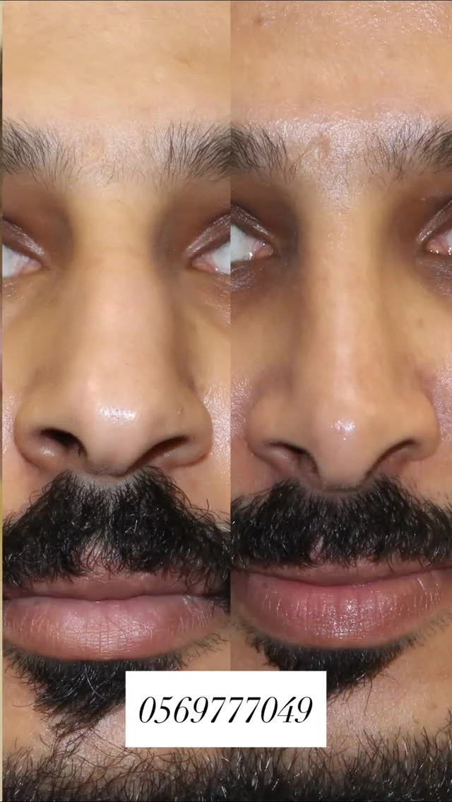مقارنة لحالة تجميل الأنف لدى رجل
