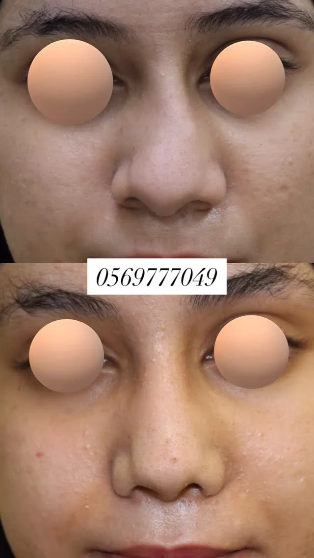 مقارنة أمامية لحالة تجميل أنف مع إخفاء العينين كما في الصورة الأصلية