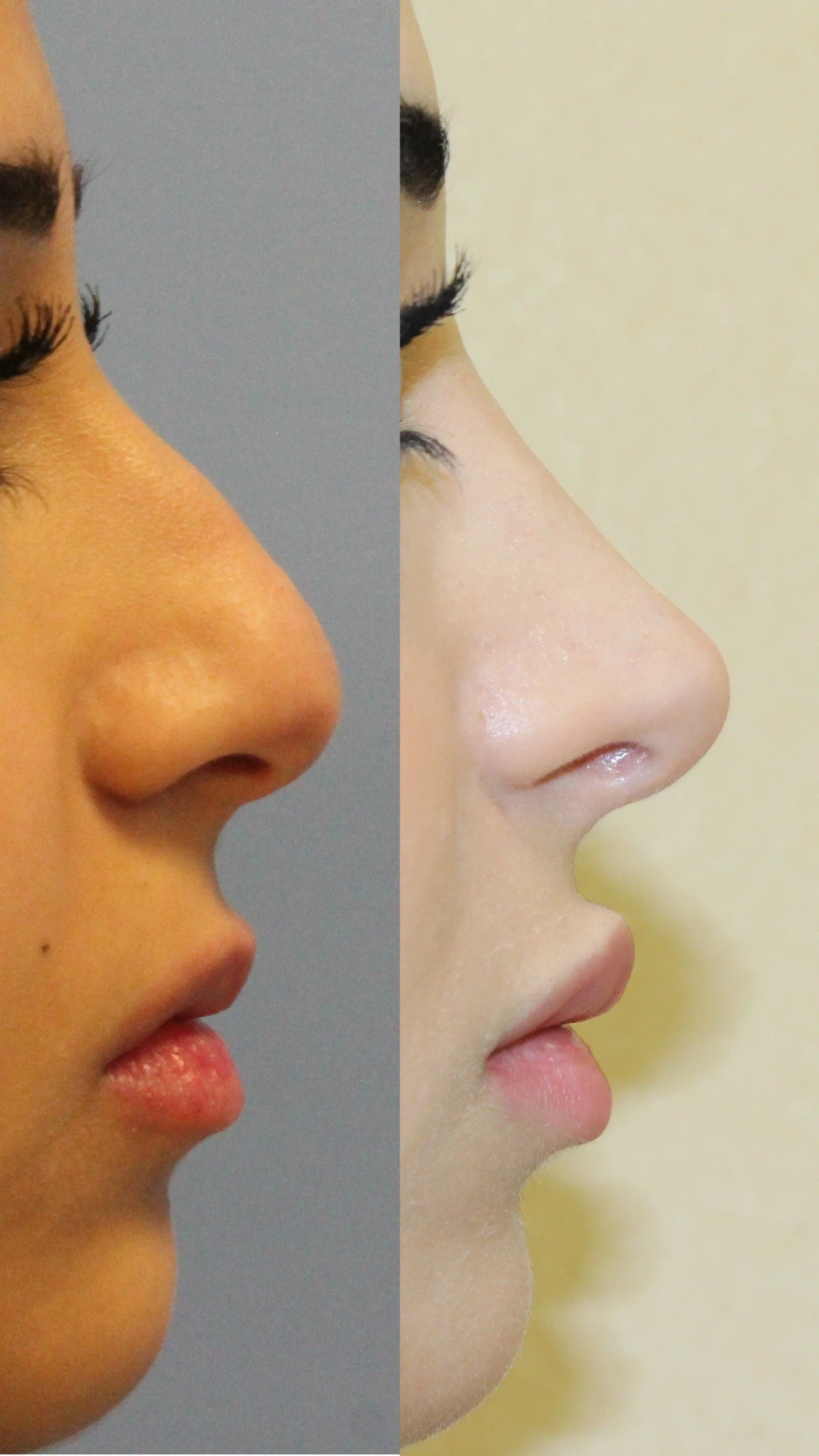 مقارنة جانبية لحالة تجميل أنف لدى د. سامر